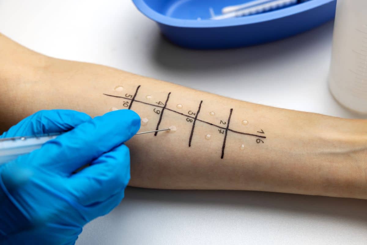 Skin prick allergy test The arm of a patient receiving an allergy test. There is a numbered grid with dots of liquid on it and a gloved hand adding further drops using a syringe.