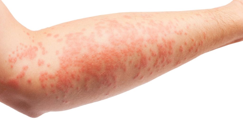 Eczema | Sacramento ENT