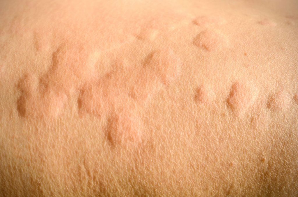 urticaria-hives